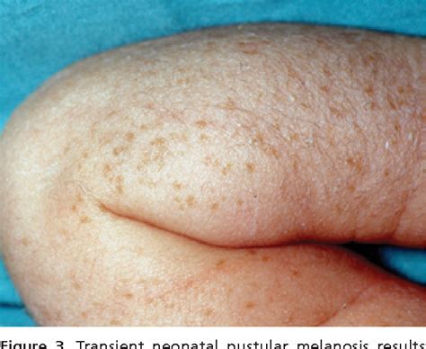 Figure 3 From Newborn Skin Part I Common Rashes Semantic Scholar