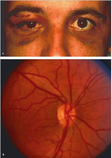 Neuro Ophthalmology Questions Of The Week Traumatic Optic Neuropathy