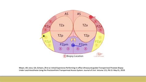 Core Videos 2020 Transperineal Prostate Biopsy Demonstration Youtube