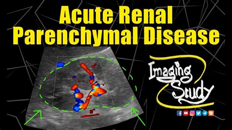 Acute Renal Parenchymal Disease Ultrasound Case 181 Youtube
