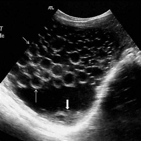 Liver Cyst Ultrasound