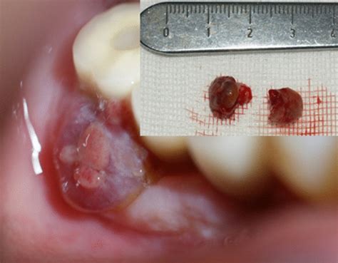 Pyogenic Granuloma Associated With A Dental Implant Download