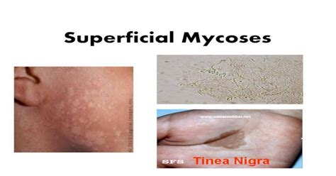 Superficial Mycoses Ksu Superficial Mycoses Fungal Infections 1