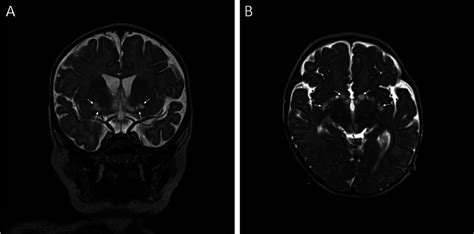 T2 Weighted Magnetic Resonance Images At Age 6 Months Of A Patient