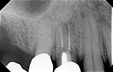 A Fluctuant Swelling On The Upper Mucolabial Fold Oral Surgery Oral