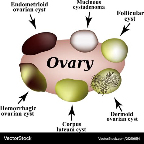 Types Of Ovarian Cysts Set Infographics Royalty Free Vector