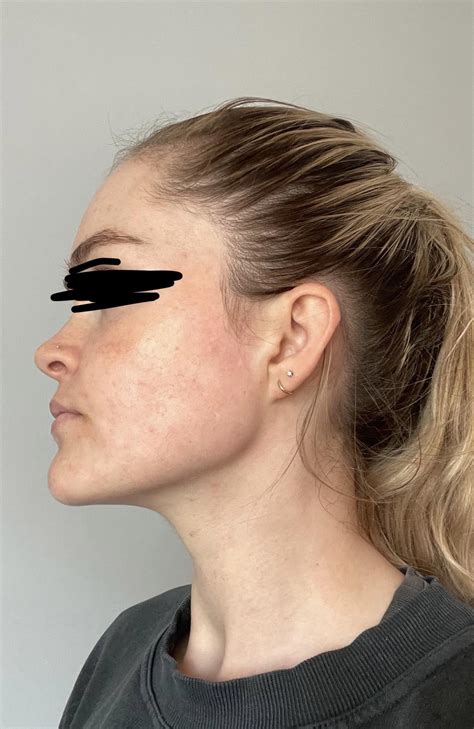 4 Ish Weeks Post Op Before And After Upper Jaw Surgery Genioplasty