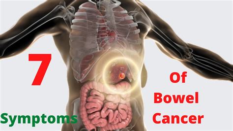 Symptoms Of Bowel Cancer Youtube