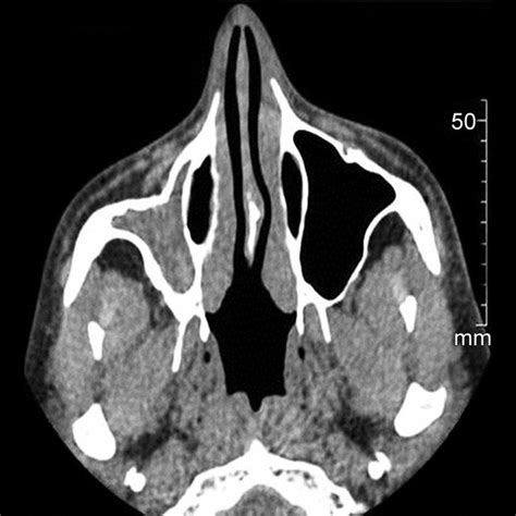 CT Scan Of Paranasal Sinus Axial View Showing Normal Ethmoid Sinus