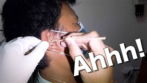 Mans Earwax Removed And Ear Cleaning Youtube