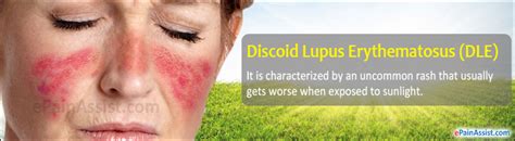 Discoid Lupus Erythematosus Dlecausessymptomstreatment