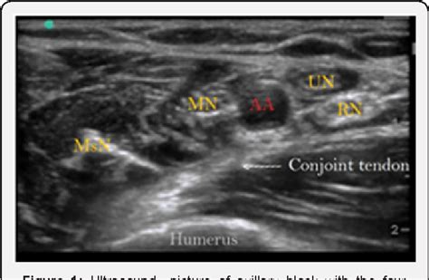 Figure 1 From Tourniquet Pain After Ultrasound Guided Axillary Blockade