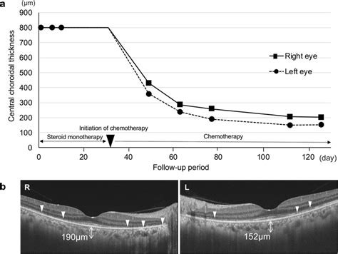 Change Of Choroidal Thickness During The Clinical Course Edi Oct