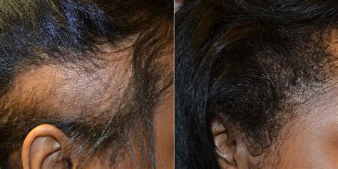hair transplant before and after photos african americans hair restoration of the south new