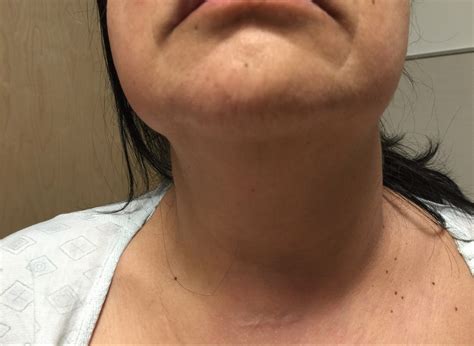 Huge Save In A Patient With Neck Swelling Ede Blog