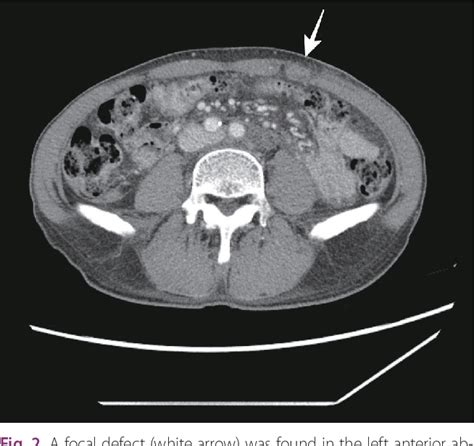 Figure 2 From Traumatic Abdominal Wall Hernia With Hemoperitoneum