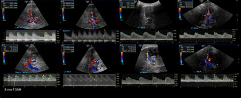 Transcranial Doppler Sonographic Tendencies Ultrasound Vascular