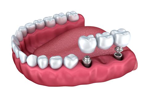 Signs You Have A Dental Implant Infection Biscayne Dental Center