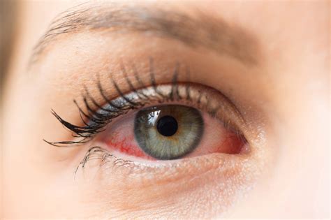 Upala oka Uzroci Simptomi i Liječenje Optometrija net