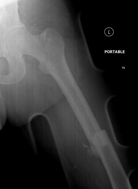Intertrochanteric Fracture Radiology Case