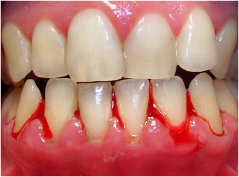 Gingivitis Causes Symptoms And Treatment