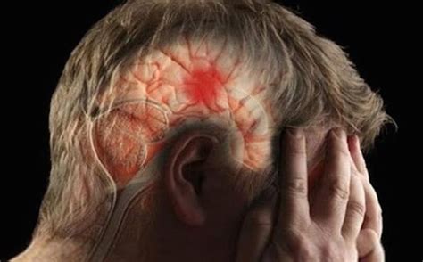 Cuáles son los signos y síntomas del accidente cerebrovascular Repretel