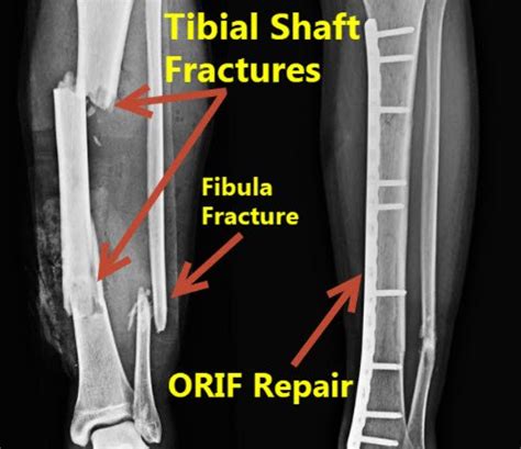 Compound Fractures X Ray