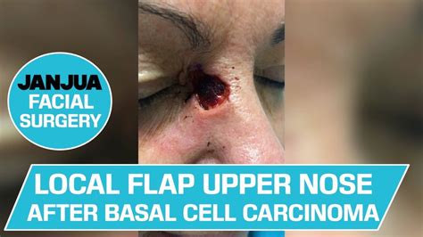 Local Flap Upper Nose After Basal Cell Carcinoma Dr Tanveer Janjua