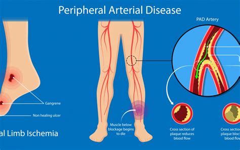 Quick Intervention Of Peripheral Artery Disease Saved 65yr Old