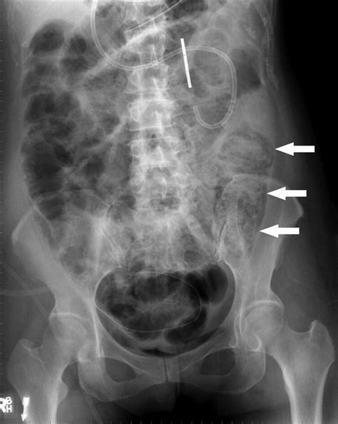 Imaging Of Acute Small Bowel Obstruction Ajr