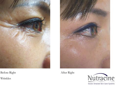 Retin A Under Eyes Before And After Pictures Picturemeta