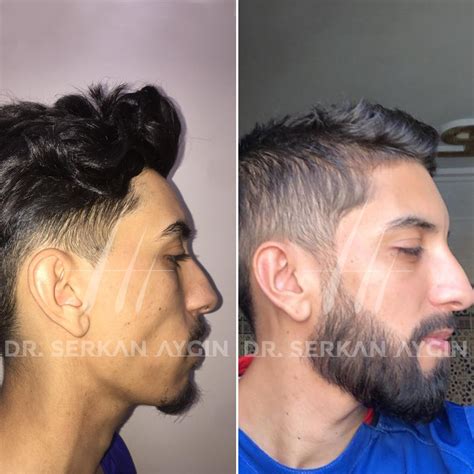 Beard Transplant Before And After Dr Serkan Aygin Clinic