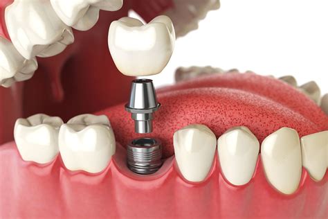 Implantes Dentales Para Recuperar Tu Sonrisa Dentologies Salud