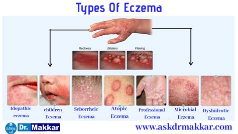 Eczema Online Homeopathic Treatment India Skin Specialist Dr Makkar