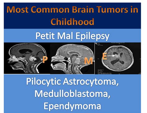 Usmle To Residency Videos Updates And More Most Common Brain Tumors