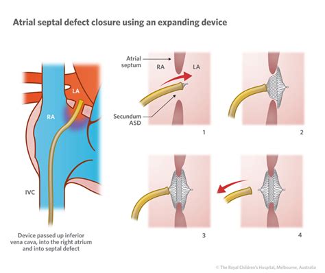 Cardiology Atrial Septal Defect