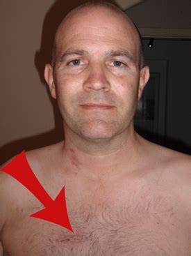 Open Heart Surgery Scars Different Types