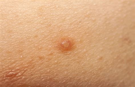 Topical Cantharidin Shows Efficacy Safety For Molluscum Contagiosum
