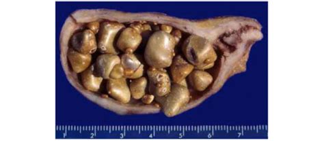 Calculo Pedra Da Vesilcula Cad Dr Zardo
