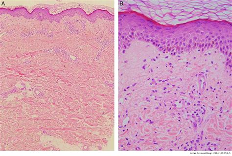 Chronic Recurrent Annular Neutrophilic Dermatosis Associated With