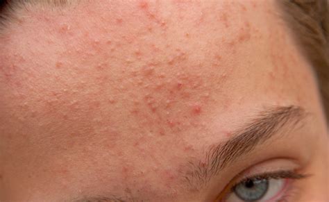 How To Treat Forehead Acne