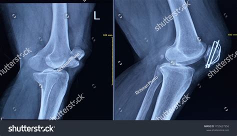 Film Xray Left Knee Lateral View Stock Photo 1755627356 Shutterstock
