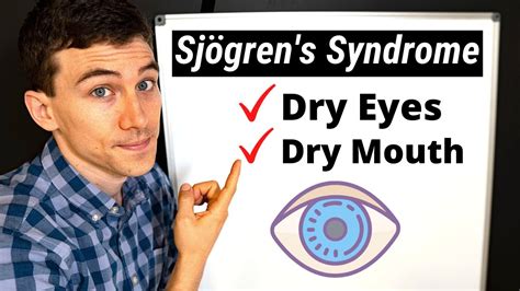 What Is Sjögrens Syndrome Eye Doctor Explains Youtube