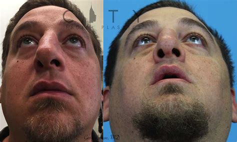 Nyc Facial Reconstructive Plastic Surgery New York Face Trauma Ues