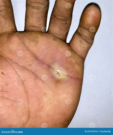 Abscess With Surrounding Cellulitis Or Staphylococcal Streptococcal