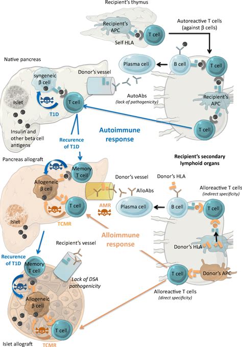 Pathophysiology Of Type 1 Diabetes Autoimmune Recurrence And Allograft