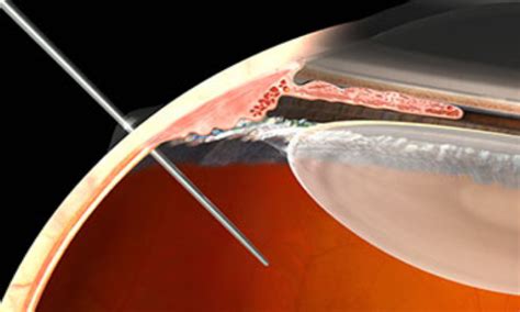 Anti Vegf Injections May Lead To Cognitive Impairment In Amd Patients