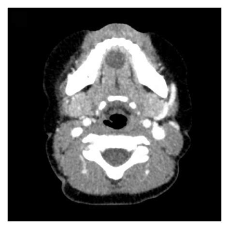 Pdf Epidermoid Cyst In The Floor Of The Mouth Of A 3 Year Old