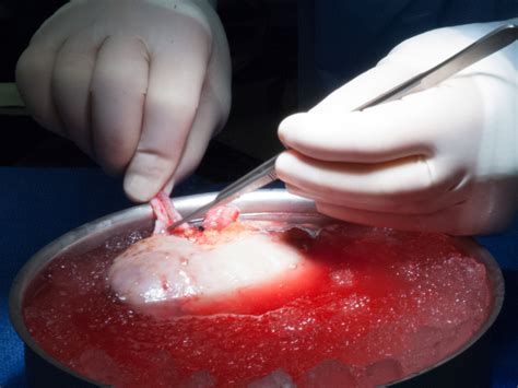 A kidney transplant is a surgical procedure to transfer of a healthy kidney from a donor to a patient for the purpose of replacing one of the failing. Using data to improve kidney transplant outcomes ...