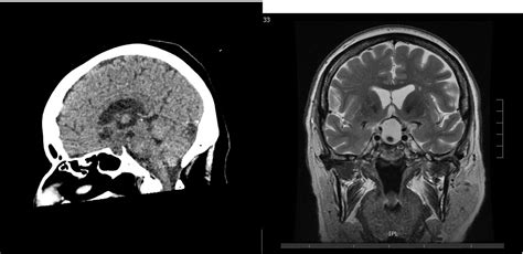 Large Pituitary Colloid Cyst Causing Visual And Hormonal Defects Bmj